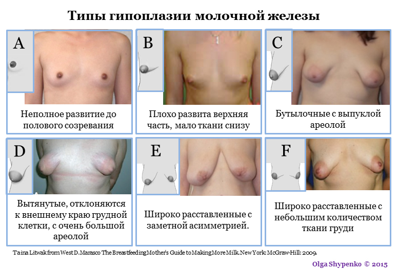 Типы гипоплазии груди