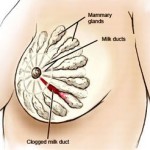 лактостаз 3