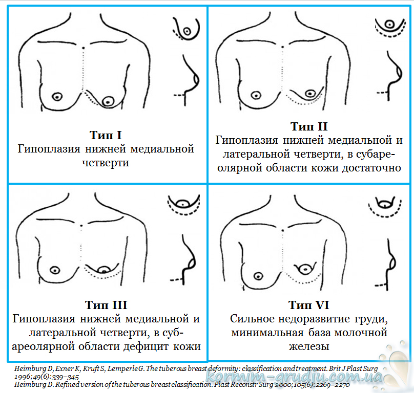 типы гипоплазии молочной железы