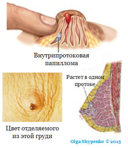 внутрипротоковая папиллома